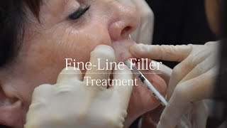 Fine Line Dermal Filler  treatment video [upl. by Sanfred]