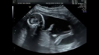 Baby Boy Ultrasound at 18 weeks [upl. by Annhoj]