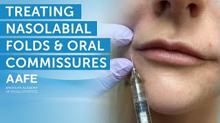 Using Dermal Fillers to Fill and Smooth Smile Lines  AAFE [upl. by Sexela]