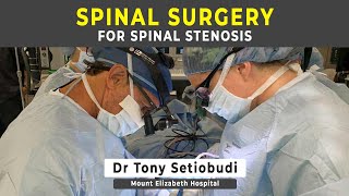 Spinal Stenosis What is it [upl. by Luthanen]