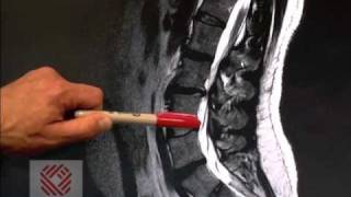 lumbar Stenosis  Everything You Need To Know  Dr Nabil Ebraheim [upl. by Sirtemed]