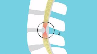 Symptoms of Cervical Stenosis  Jeffrey Cantor MD [upl. by Cowie]