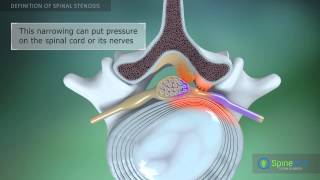 QampA  Spinal Stenosis [upl. by Osei]