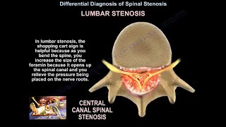 Spinal Stenosis  Everything You Need To Know  Dr Nabil Ebraheim [upl. by Liggett]