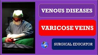 How to cure varicocele naturally [upl. by Phelan]